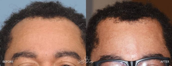 Parasagittal skull augmentation before and after by Dr. Barry Eppley