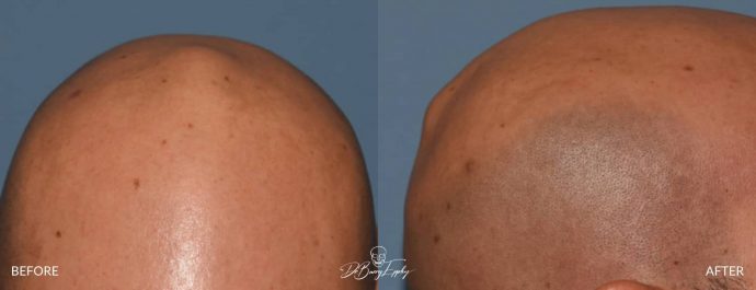 Skull reshaping before and after