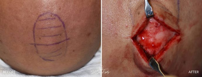 Skull reshaping before and after