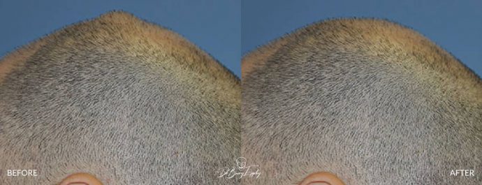 Skull reshaping before and after