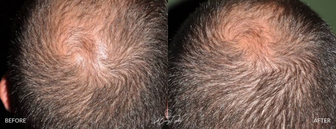 Skull reshaping before and after