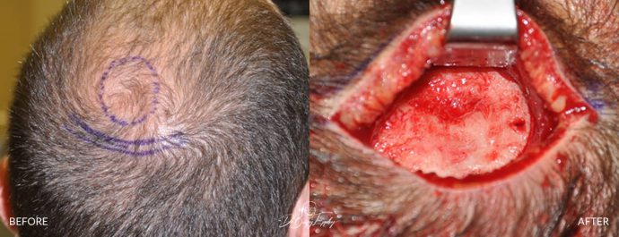 Skull reshaping before and after