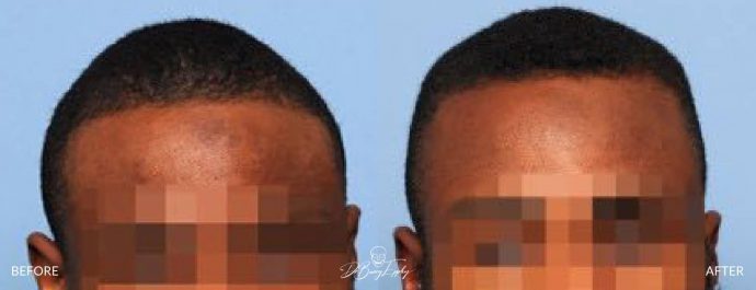 Square custom skull implant before/after front view Dr Barry Eppley