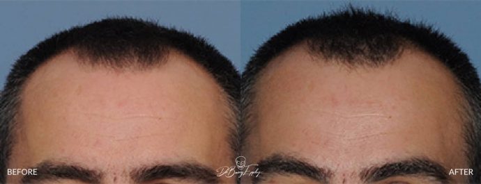 Small heightening custom skull implant before and after Dr Barry Eppley