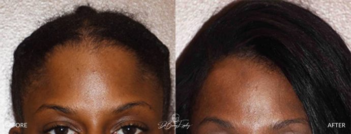 large heightening custom skull implant before and after front view Dr Barry Eppley