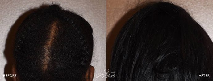 large heightening custom skull implant before and after back view Dr Barry Eppley