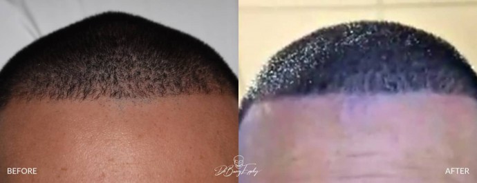 Before and after of male sagittal skull reduction by Dr. Barry Eppley