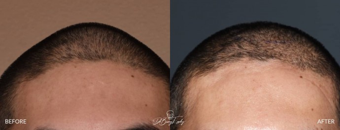 Anterior sagittal skull prominence front view before and after by Dr. Barry Eppley