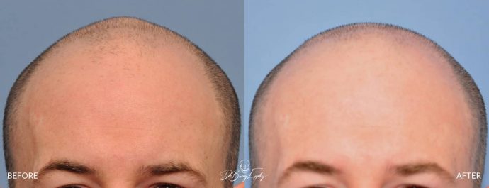Skull reshaping before and after by Dr. Barry Eppley