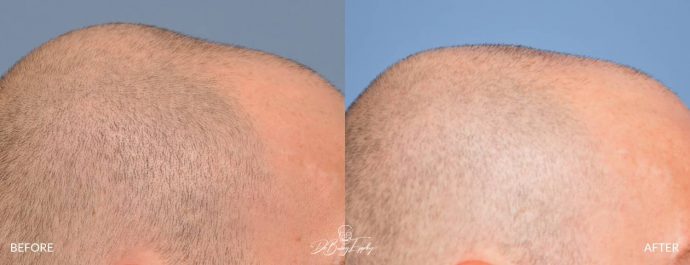 Skull reshaping before and after by Dr. Barry Eppley