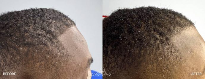 Skull reshaping before and after by Dr. Barry Eppley